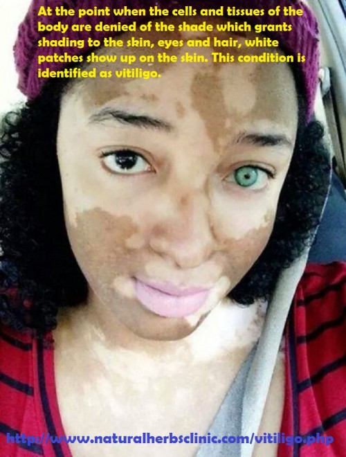 Skin disorder Vitiligo Symptoms and signs contain the arrival of uneven white patches, or numerous degrees of depigmentation on the body... http://naturalherbsclinic.classtell.com/naturalherbsclinic_2/symptomscomplicationsandtreatmentforvitiligoskindisorder