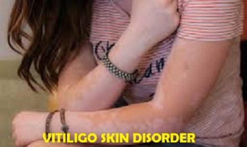 The Vitiligo Symptoms contain an often fast pigment loss on numerous areas of the skin. The initial arrival of the white patches can be followed by a steady period without any development of the disorder..... http://best-natural-herbs.jigsy.com/entries/skin-white-patches/symptoms-diagnosis-and-treatment-of-vitiligo-skin-disorder