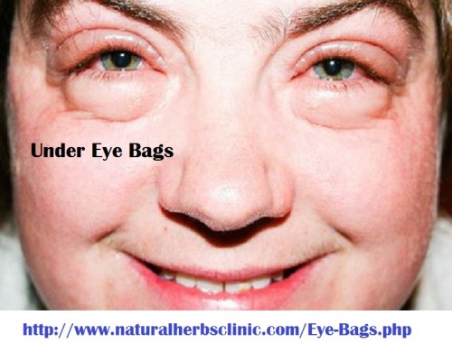 As the name suggests, creation of bag like structures everywhere the eyes is one of the main symptoms of this disorder. Further Symptoms of Eye Bags that support a consultant diagnoses this situation so that a suitable treatment.... http://www.naturalherbsclinic.com/blog/7-home-remedies-for-eye-bags/