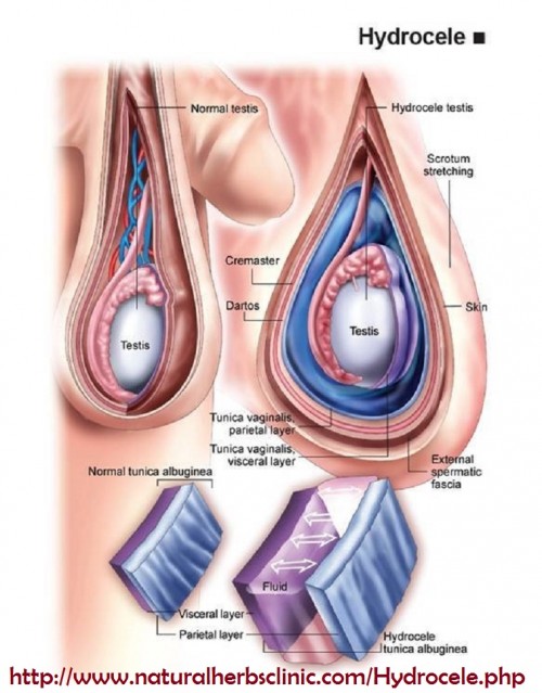 Frequently a hydrocele does not reason symptoms. You may notification development of your scrotum. Hydrocele Symptoms, when happen, can contain pain, inflammation, or redness of the scrotum or a sensation of density at the base of the penis.... http://herbclinic.inube.com/blog/5636475/symptoms-and-herbal-treatment-of-hydrocele/