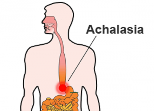 The Achalasia Symptoms are containing Struggle in swallowing food, Struggle swallowing both liquid and solid food, Regurgitation of food that is recollected in the esophagus. If this occurs at night, food might be aspirated into the lungs, a thoughtful medical issue, Chest uneasiness from esophageal dilation and/or recollected food, Sharp chest soreness commonly of uncertain cause, etc... http://achalasiaanditstreatment.blogspot.com/2017/01/symptoms-and-natural-treatment-of.html