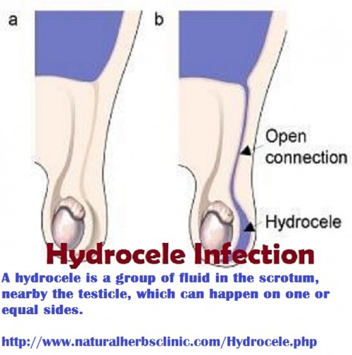 Get information about medicines to recover hydrocele from your confidential way Natural Herbs Clinic. We have Hydrocele Herbal Remedies for the positive recovery of hydrocele.... https://disqus.com/home/discussion/channel-naturalherbsclinic/herbal_remedies_for_hydrocele/