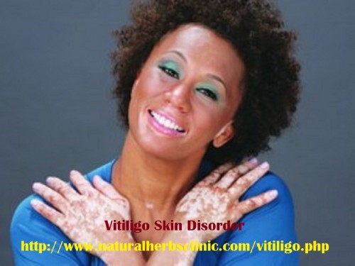 Natural Herbs Clinic is one of the famous sites in the world where you can find successful solution of vitiligo skin infection. Vitiligo Herbal Remedy provided by Natural Herbs Clinic is very useful formula for the treatment of vitiligo without any side effects.... https://www.youtube.com/watch?v=oPBoHvP5xro