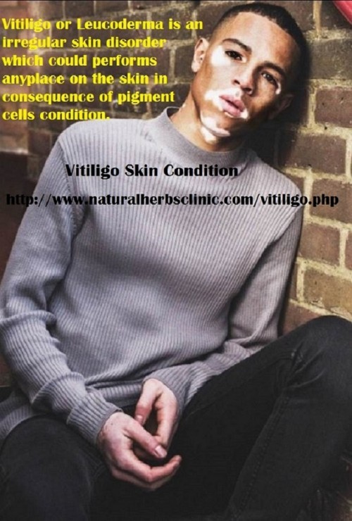 Vitiligo grows gradually. Symptoms of Vitiligo does not have one of a kind to only it subsequently you can simply depend on signs. This is routinely the event of minimal white spots on the areas of the skin... http://www.naturalherbsclinic.com/blog/symptoms-and-natural-treatment-method-for-vitiligo/