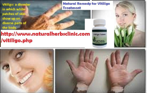 Melanin production can be stimulated using a combine of basil leaves extract and lime juice. This Vitiligo Treatment has no side effects and is completely safe for patients suffering from vitiligo.... https://www.solaborate.com/naturalherbs-clinic/blog/the-bestway-to-get-rid-of-vitiligo-without-side-effect/aec254ca-24ee-4a75-9c10-ae59b976a25f