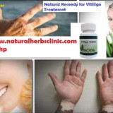 The-Best-Way-to-Get-Rid-of-Vitiligo-without-Side-Effect