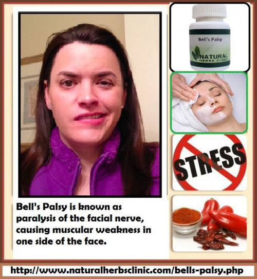 During the Treatment Bell’s Palsy is good to avoid caffeine and other stimulants, alcohol, and smoking. All of these place stress on the body that can guide to symptoms of Bell’s palsy in sensitive individuals.... http://herbsclinic.edublogs.org/2017/11/01/bells-palsy-prevention-with-natural-remedies/