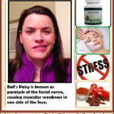 Treatment-Bells-Palsy