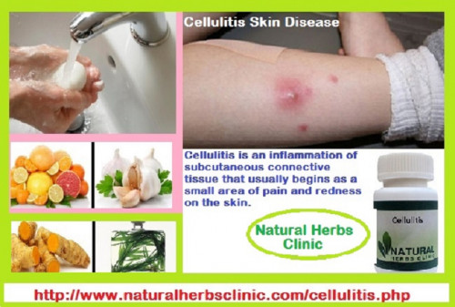 Treatment of Cellulitis at home includes religiously taking prescribed antibiotics to help treat the infection. The normal oral antibiotics are those coming from the penicillin family such as flucloxacillin... http://www.naturalherbsclinic.com/blog/treatment-of-cellulitis-skin-infection/
