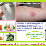 Treatment-of-Cellulitis-Skin-Infection