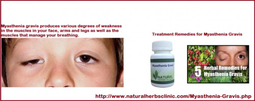 If the symptoms are fierce, and the disease is diagnosed, then Treatment of Myasthenia Gravis can begin immediately.  Medical treatment is critical for this disease. Natural treatment can also help a patient to manage with the symptoms of this disease.... http://bit.ly/2ixZegE