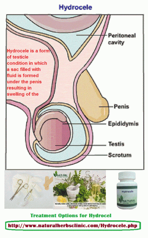 Maximum hydroceles resolve without medical handling. However, if the situation reasons uneasiness or develops extremely large, recovery may be required. There are 2 techniques of hydrocele treatment that are aspiration and hydrocelectomy (surgery)..... http://hydrocele-treatment.webnode.com/hydrocele-symptoms-and-causes-treatment-for-hydrocele/