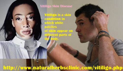 The vitiligo skin disease is a particularly difficult condition. Like I stated earlier, currently there is no cure for vitiligo. But there are lots of treatments out there that can decrease some of the symptoms. With that being said, if you have vitiligo your best protection is information. You should find out everything that you can about the disease, its cause, and treatments.... http://naturalherbsclinic.bcz.com/2017/10/19/treatment-for-vitiligo-skin-disease/