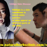 Vitiligo-Herbal-Treatment