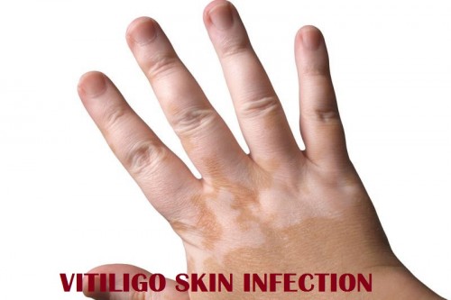 The leading Vitiligo Symptoms are white patches or spots on the skin. Initially, the vitiligo might begin as a patch that is minor paler than the rest of your skin but will slowly become totally white. The edges of the patch might be flat or unequal and might have an inflamed red border... http://vitiligosymptoms.webnode.com/vitiligo-disorder/