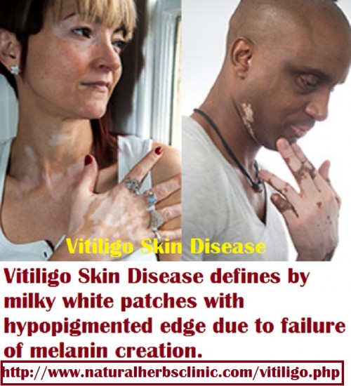 Vitiligo Skin Disease defines by milky white patches with hypopigmented edge due to failure of melanin creation. Vitiligo can run in families too. Kids whose parents have the condition are other likely to produce vitiligo. Though, most kids will ‘not get vitiligo even if a parent has it... http://vitiligosymptom.blogspot.com/2017/02/vitiligo-its-complications-symptoms-and.html