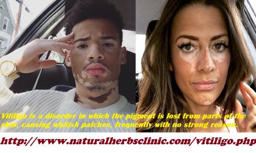 The most noticeable Vitiligo symptoms are loss of pigment on the smooth skin, subsequent in generating milky-white, unevenly formed patches on it. Other symptoms of vitiligo disease, the skin cells do not create sufficient melanin. For a few people this can occur rapidly, although for others the patches may stay the similar for months or years.... http://www.naturalherbsclinic.com/vitiligo.php