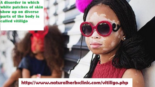 The main Vitiligo Symptoms is pigment loss that creates milky-white patches (depigmentation) on your skin. Other less common signs may contain:  Premature whitening or graying of the hair on your scalp, eyelashes, eyebrows or beard Loss of shade in the tissues that line the inside of your mouth.... http://herbelsolution.jimdo.com/2016/12/09/vitiligo-symptoms-signs/