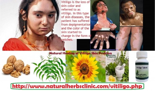 Skin discoloration, Premature whitening or graying of the hair on your scalp, eyebrows, eyelashes, Loss of color in the tissues that line the inside of your mouth and nose, Discolored patches around the armpits, navel, genitals and rectum are some of the key Vitiligo Symptoms and signs... http://naturalherbsclinic.blogginger.com/vitiligo-natural-treatment/