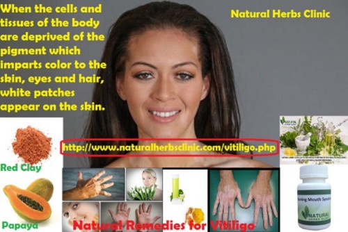 Turmeric is the most straightforward for vitiligo treatment naturally. This blood purifier will reestablish the pigmentation and evacuate your shame.... http://herbsmedication.tumblr.com/post/151457857339/5-natural-remedies-for-vitiligo-how-to-treat