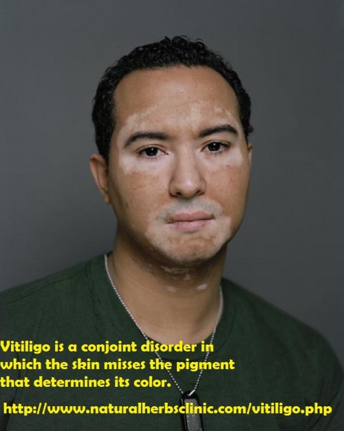 The main Vitiligo Symptoms are when a unexpected onset is realized in most cases where the patient view a single, few or numerous milky white patches of uneven forms and sizes on the skin. Minor parts of de-pigmentation slowly begin increasing to contain larger parts of the body... http://vitiligosymptom.blogspot.com/2017/02/vitiligo-its-complications-symptoms-and.html