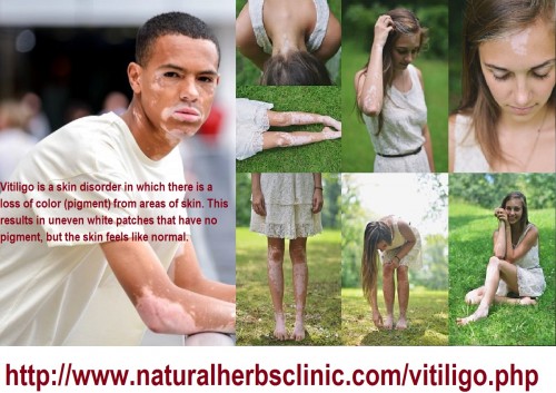 Traditional vitiligo might start any time after birth and frequently seems as a white spot without other Vitiligo Symptoms on a background of usually pigmented skin.... https://www.behance.net/gallery/46505067/What-Are-Symptoms-and-Signs-of-Vitiligo