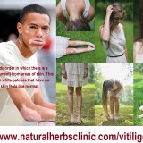 WhatAreSymptomsandSignsofVitiligo