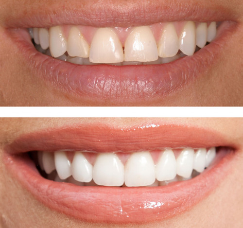 Address: 5989 168 St,  #1 Surrey, BC V3S 3X5, Canada
Phone: 604-574-4000
Email: info@5cornerdental.com
Website: www.5cornerdental.com

At 5 Corner Dental, we are devoted to restoring and enhancing the natural beauty of your smile using conservative, state-of-the-art procedures that will result in beautiful, long lasting smiles!

Socially Responsible
At 5 Corner Dental, we believe in giving back to our community through our annual 5 Corner Community day, with prizes for children and complementary dental consultation through out the community. We have also invested in Modern technology such as digital xrays, to reduce our impact on the environment and reduce the use of chemicals.
A Positive Experience
Building a foundation of trust by treating our patients as special individuals is vital to our success.  We understand how uneasy some patients may feel about their dental visits, and how we can make a difference in providing a relaxing and positive experience.  Our entire team is dedicated to providing you with excellent, personalized care and service to make your visits as comfortable and pleasant as possible. We have TVs in all Treatment rooms and reception area for your leisure. your children can keep busy with educational books, play area and the game console while you get your treatment done. We are looking forward to serving you and your family.
High Standards
A standard of excellence in personalized dental care enables us to provide the quality dental services our patients deserve.  We provide comprehensive treatment planning and use restorative and cosmetic dentistry to achieve your optimal dental health. Our office is equipped with digital record keeping  (no more paper charts!!!) for maximum security and confidentiality of your records. We also use digital x-rays to minimize your exposure to radiation and harmful chemicals that were used to develop the traditional x-rays. Intra-oral cameras are used to take detailed pictures of the teeth to maximize patient education. Should a dental emergency occur, we make every effort to see and care for you as soon as possible. Please let us know how we can make your visit more enjoyable and comfortable.
Education & Prevention
As a practice, we are true believers that preventative care and education are the keys to optimal dental health.  We strive to provide “dental health care” vs. “disease care”.  That’s why we focus on thorough exams – checking the overall health of your teeth and gums, performing oral cancer exams, and taking x-rays when necessary.  We also know that routine cleanings, flossing, sealants, and fluoride are all helpful in preventing dental disease.  Not only are we focused on the beauty of your smile, we’re also concerned about your health.  A review of your medical history can help us stay informed of your overall health, any new medications, and any illnesses that may impact your dental health.
Uncompromising Safety
Infection control in our 5 Corner Dental office is also very important to us.  To protect our patients and ourselves, we strictly maintain sterilization and cross contamination processes using standards recommended by BC dental association. All our potential cross contamination surface are either touch-less or foot controlled. Our sterilizers you the power of steam and pressure to sterilize the instruments instead of using chemicals which can be hazardous to staff and patients alike. 
Training & Expertise
As your dental health professionals in Cloverdale, we want you to be confident knowing that we are a team of highly trained and skilled clinicians.  We pride ourselves in providing the care you need to keep your smile healthy.  To give you the best possible service and results, we are committed to continual education and learning.  We attend dental lectures, meetings, and dental conventions to stay informed of new techniques, the latest products, and the newest equipment that a modern dental office can utilize to provide state-of-the-art dental care.  Also, being members of various professional dental associations helps us to stay abreast of the changes and recommendations for our profession.

We thank you for allowing us to take care of your dental needs and look forward to serving you.
Make an appointment today…..we’ll give you a reason to smile!
