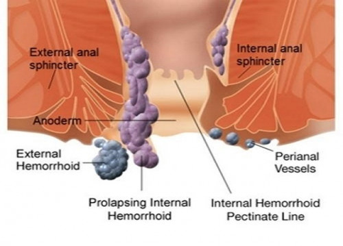 piles-treatment-piles-treatment-in-ayurveda-piles-home-remedies-piles-treatment-at-home-10.jpg