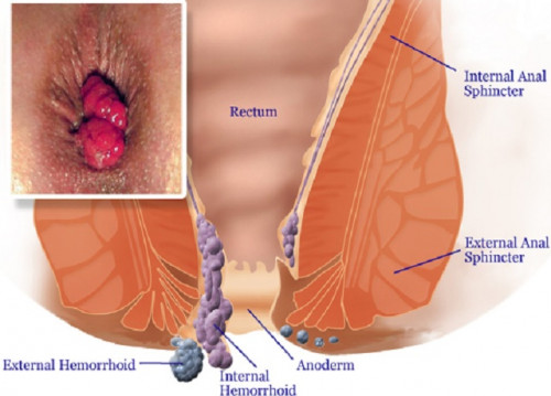 piles-treatment-piles-treatment-in-ayurveda-piles-home-remedies-piles-treatment-at-home-11.jpg